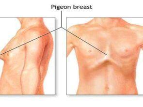 鸡胸和正常人区别图片 怎么判断是不是鸡胸-第2张图片-爱薇女性网