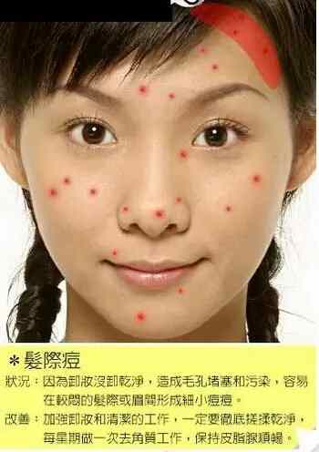 脸部各个部位长痘痘的原因示意图以及改善办法-第10张图片-爱薇女性网